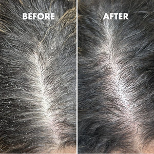Close-up before and after comparison of a scalp showing reduced dandruff and cleaner hair parting